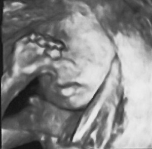 24-Schwangerschaftswoche-3d-Ultraschall