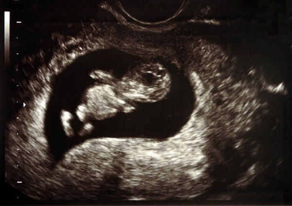 Embryo in der 11 ssw